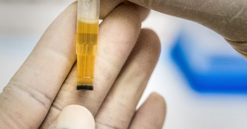How Do Urine Tests Help Identify Kidney Disease 
